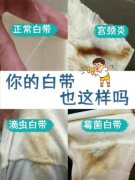 白带异常各种症状图片大全 正常白带是什么样子的真实图片